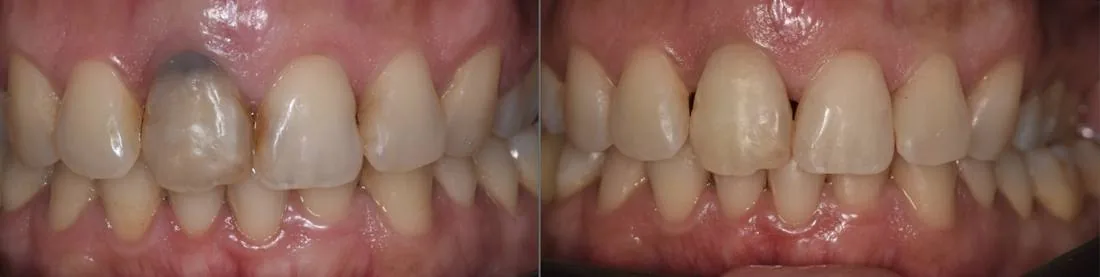 Blanqueamiento interno y externo, y operatoria: antes y después