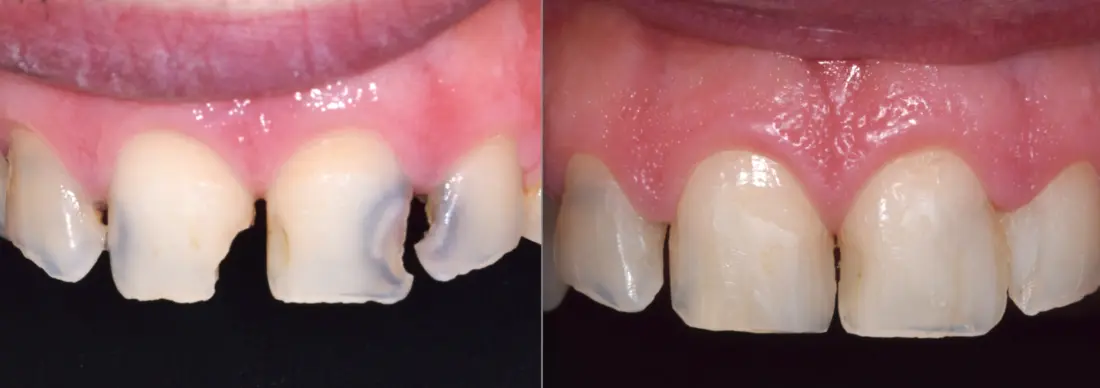 Resinas en dientes anteriores: antes y después