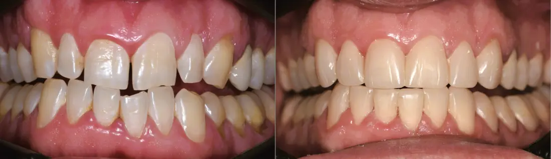 Resinas, rehabilitación estética integral: antes y después