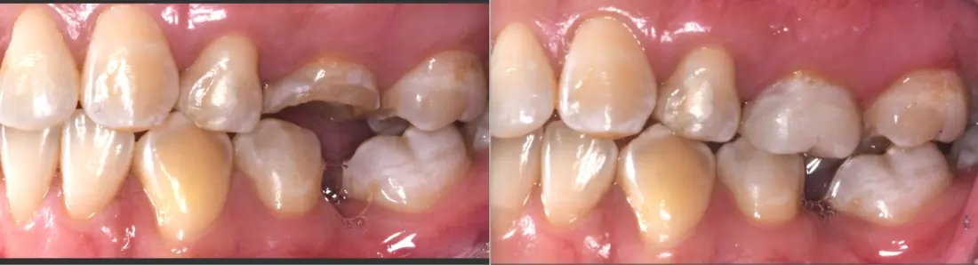 Incrustación: antes y después