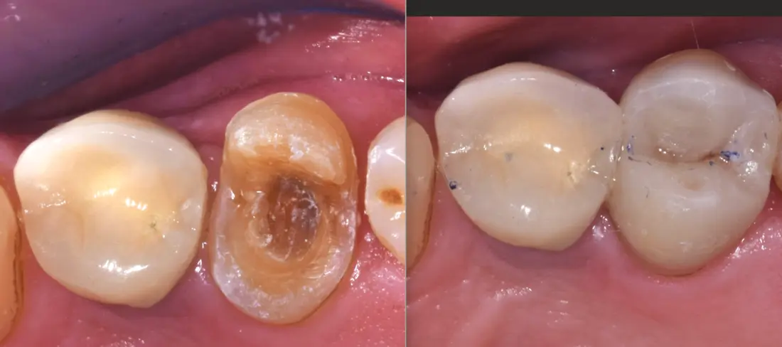Incrustación oclusal: antes y después