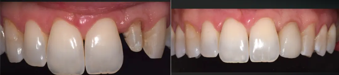 Incisivo lateral: antes y después