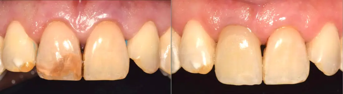 Implante en la pieza 11: antes y después
