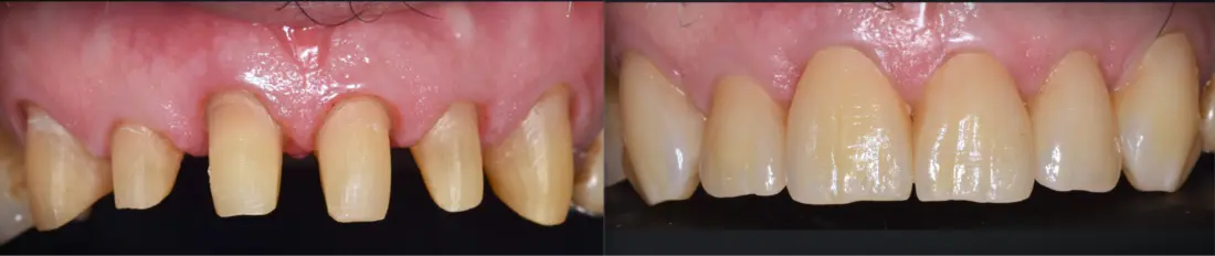 Preparaciones y coronas: antes y después