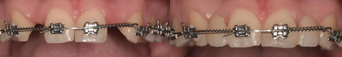 Provisorios: antes y después