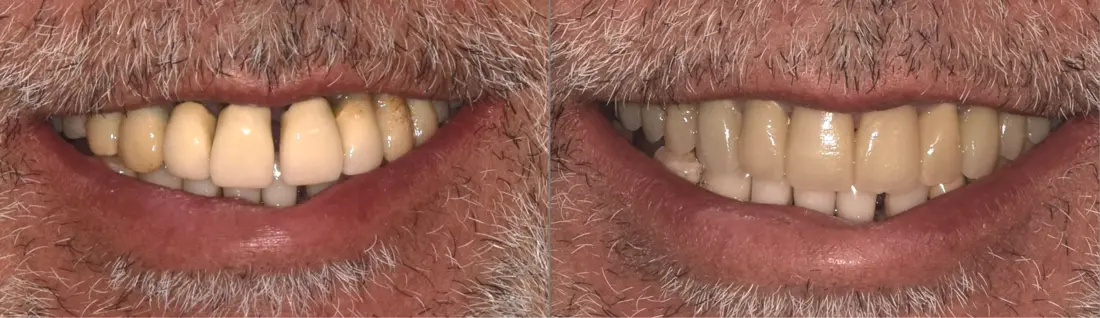 Provisorios: antes y después