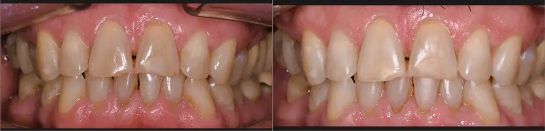 Blanqueamiento externo: antes y después