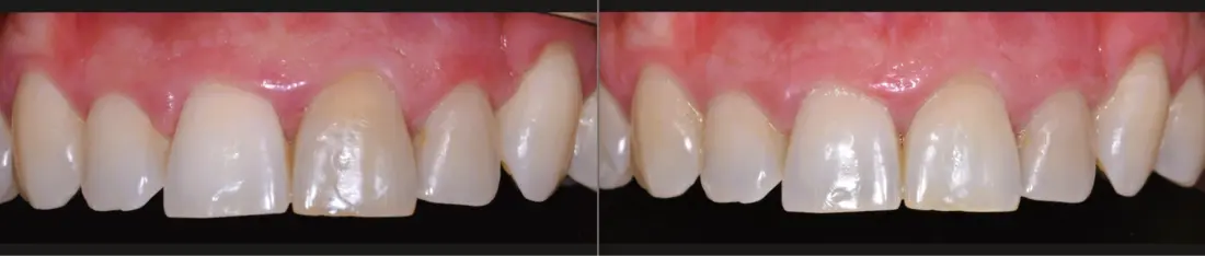 Blanqueamiento interno de la pieza 21: antes y después
