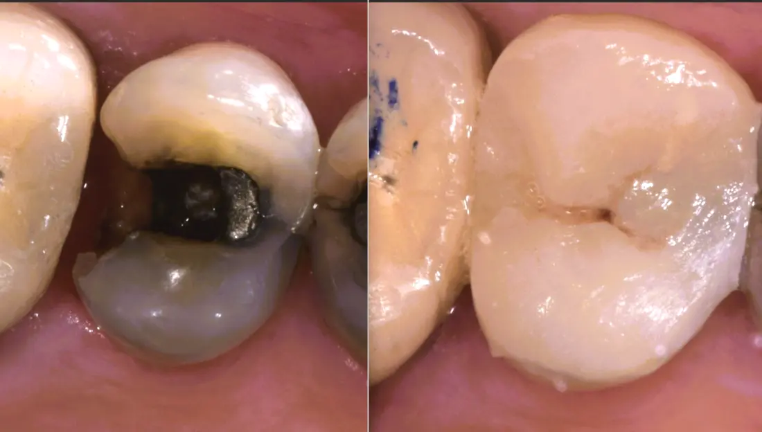 Incrustación oclusal: antes y después