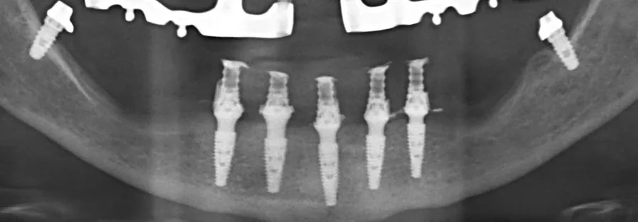 Radiografía panorámica con los implantes colocados