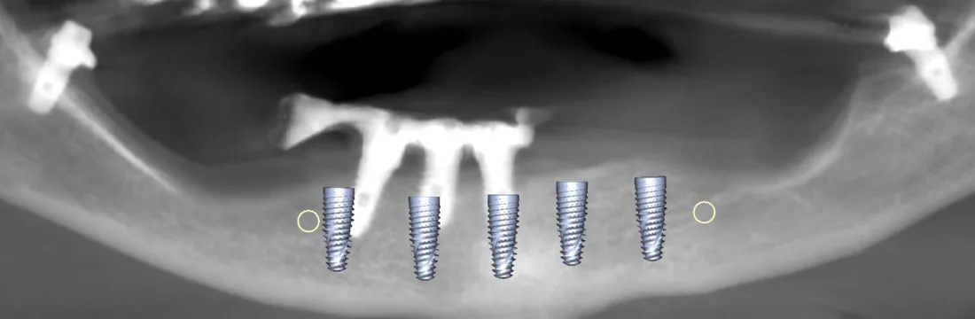 Planificación digital de cinco implantes inferiores