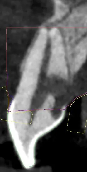 Tomografía que muestra la reabsorción dentinaria