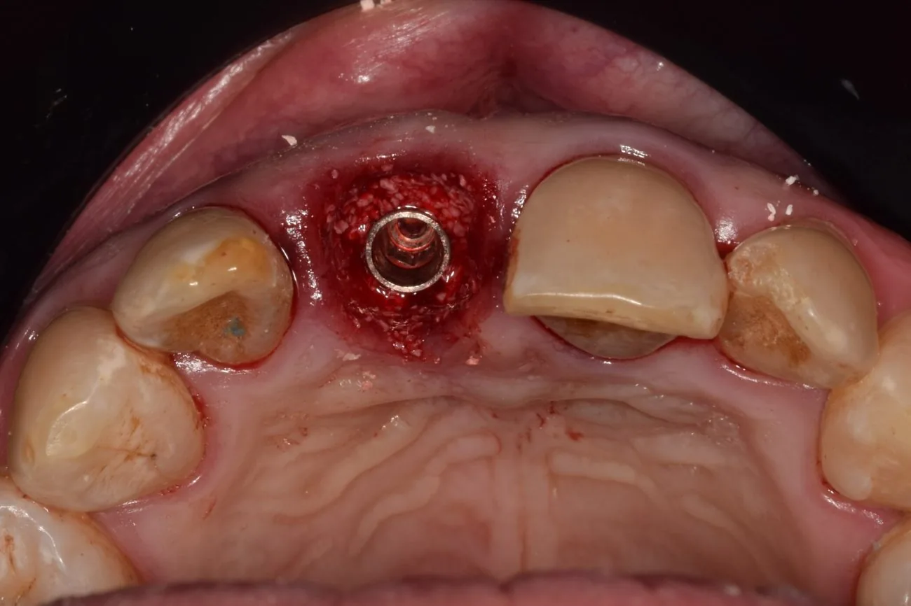 Implante e injerto óseo, vista oclusal