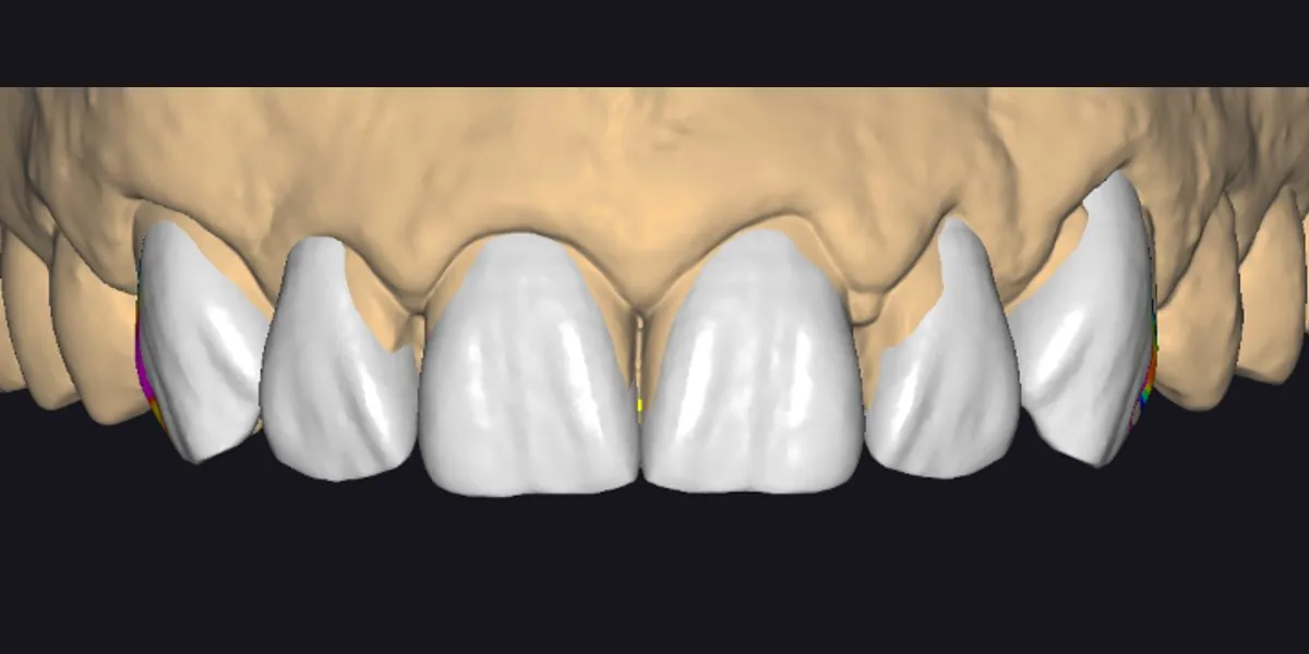Diseño digital de los dientes anteriores